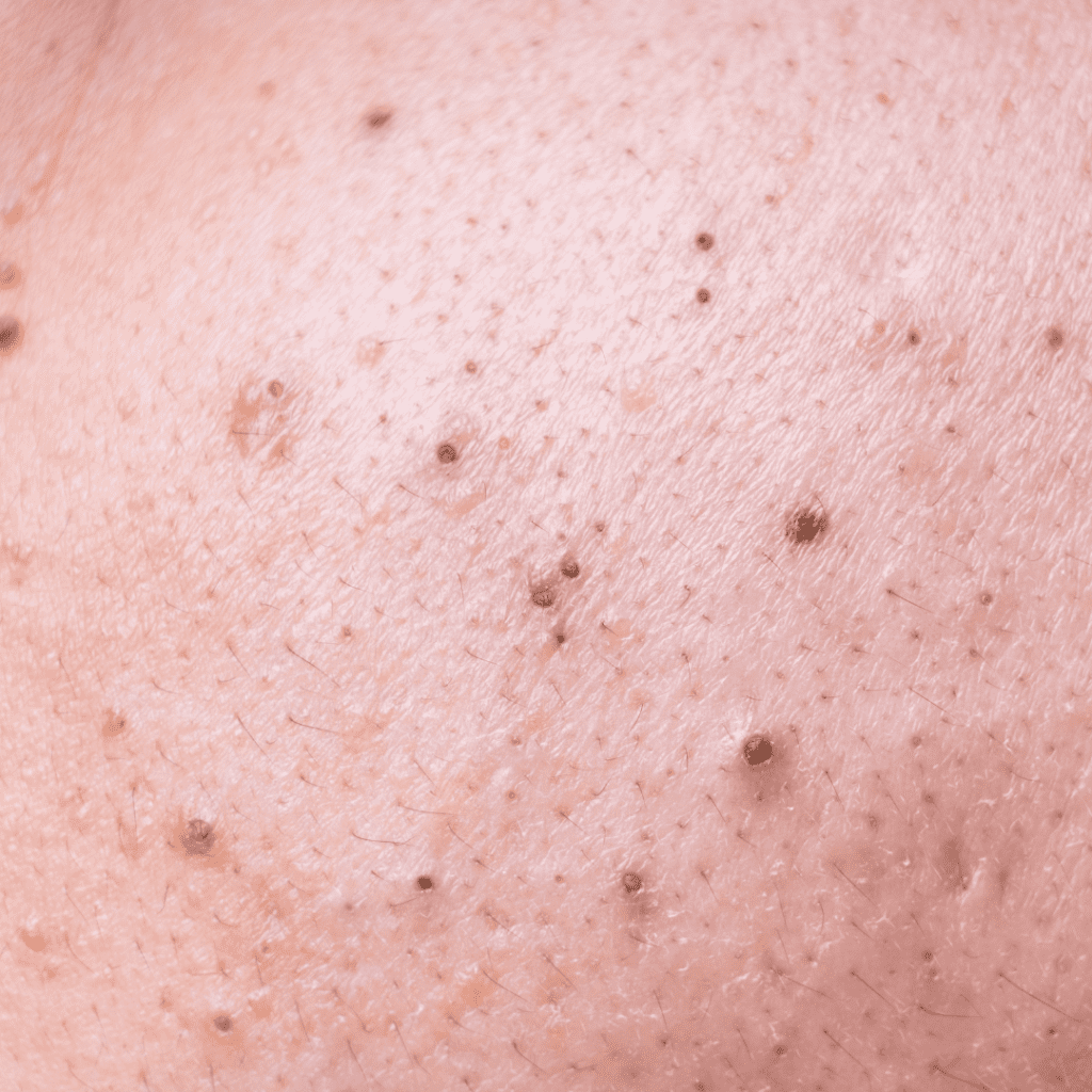 Puistjes, mee-eters en acne ontstaan meestal als gevolg van overmatige talgproductie, verstopte poriën en ontstekingsreacties op de huid.
